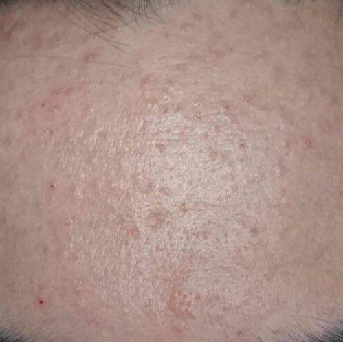 pickel an backe pickel an backe