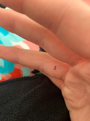 2 Kleine Punkte Am Finger Bedeutet Das Etwas Gesundheit Und Medizin 2 Kleine Punkte Am Finger Bedeutet Das Etwas Gesundheit Und Medizin