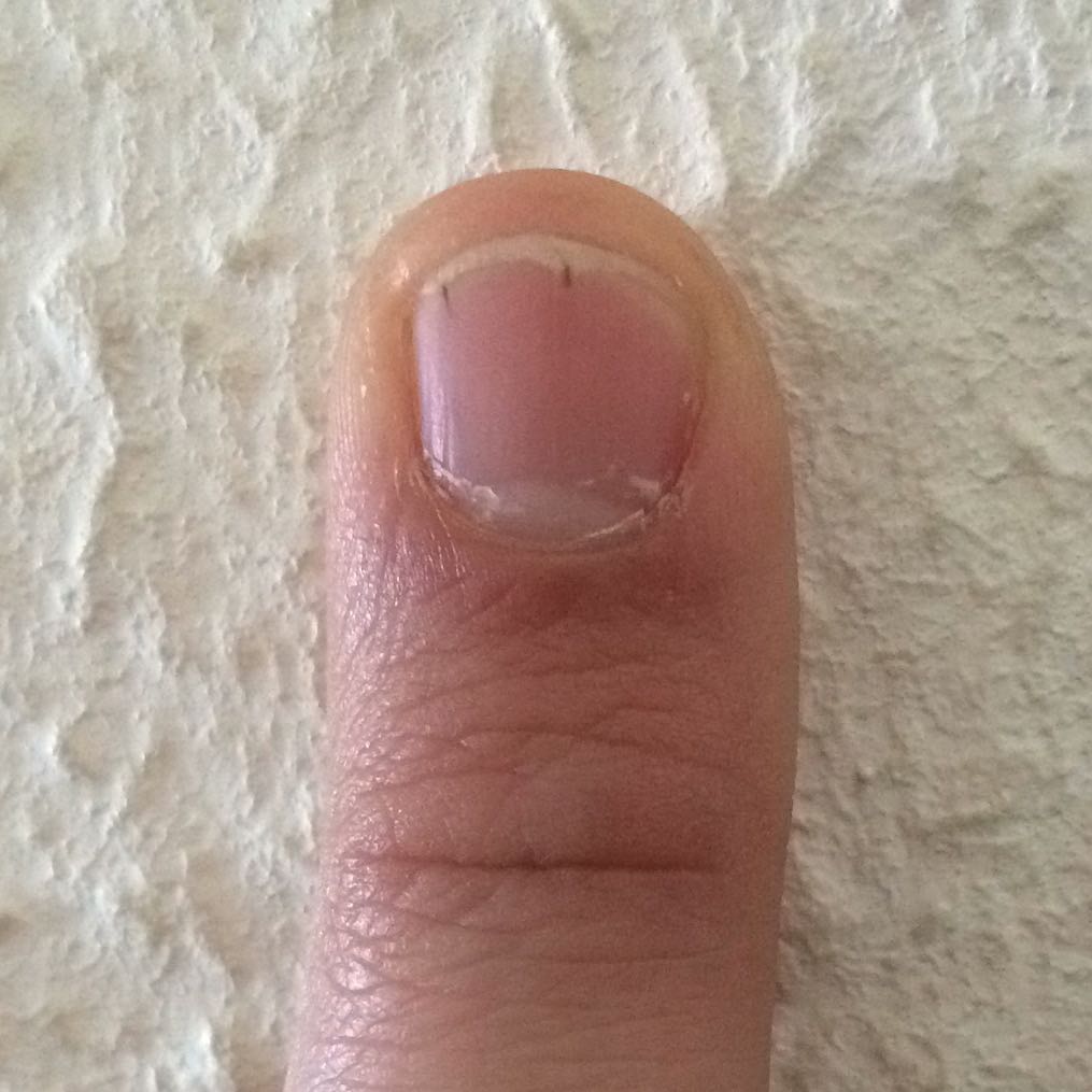 2 kleine Striche im Nagel? (Arzt, Nägel, schwarz)