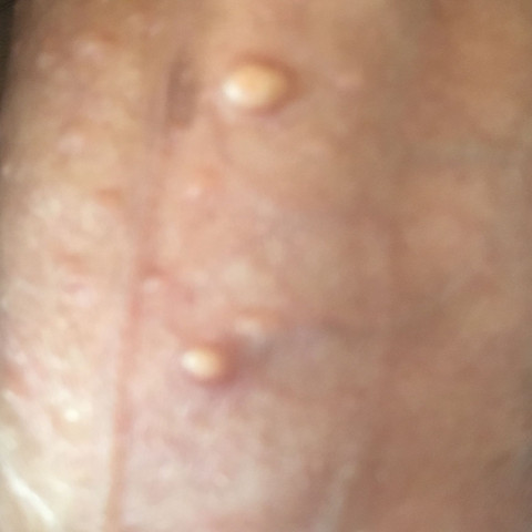2 Pickel Am Pe Is Entfernen Gesundheit Manner Haut 2 Pickel Am Pe Is Entfernen Gesundheit Manner Haut