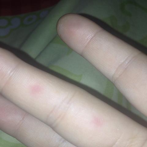 Mein Finger wo die Punkte sind  - (Haut, Insekten, stechen)