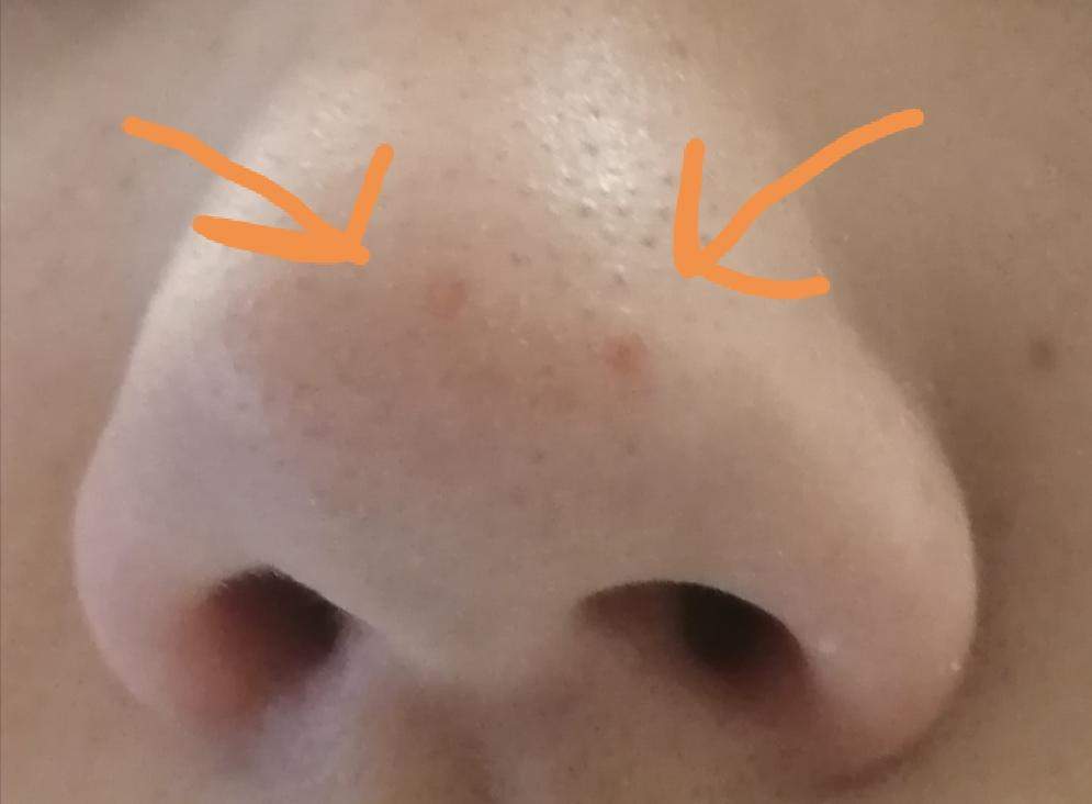 2 rote Punkte auf der Nase? (Medizin, Arzt, Haut)