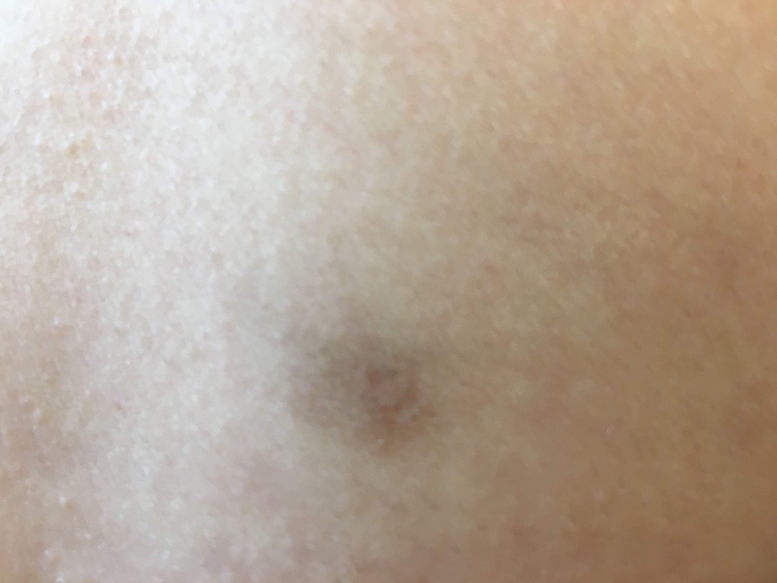 2 symmetrische blaue flecken am rücken heilt nicht ab? (Gesundheit, Hautpflege, Hautprobleme)