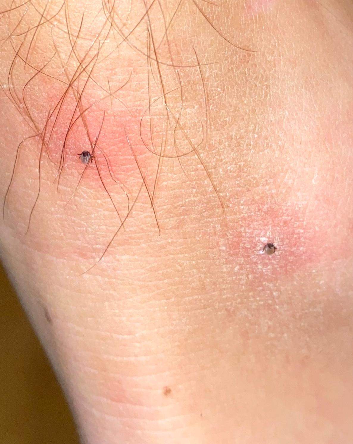 2 Zeckenbisse am Fuß schlimm? (Gesundheit und Medizin, Gesundheit, Zecken)