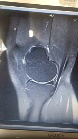 Knie Rechts Seitenbild - (Knie, MRT, Knorpelschaden)