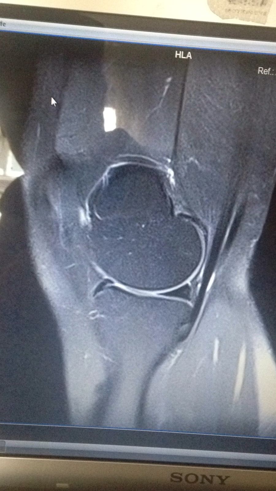 22Jahre alt und Knorpelschade hinter der Kniescheibe Grad 3-4? (Knie
