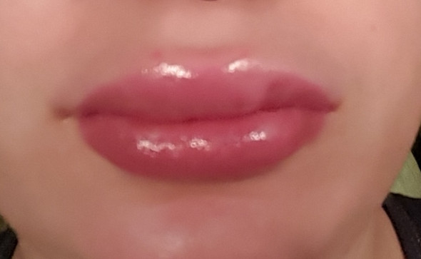  - (Schwellung, Hyaluronsäure, lippenaufspritzung)