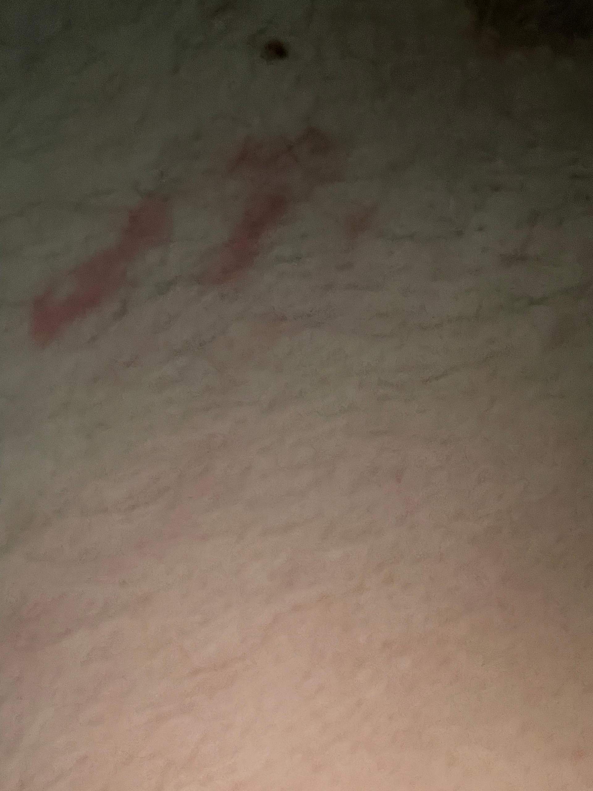 roter fleck auf der brust bilder