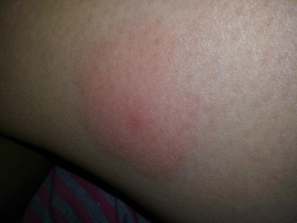 3 Tage Nach Zeckenbiss Rot Und Angeschwollen Zudem Juckt Es Noch Ist Das Normal Oder Sollte Ich Lieber Damit Mal Zum Arzt Gesundheit Sommer Beine 3 Tage Nach Zeckenbiss Rot Und Angeschwollen Zudem Juckt Es Noch Ist Das Normal Oder Sollte Ich Lieber Damit Mal Zum Arzt Gesundheit Sommer Beine