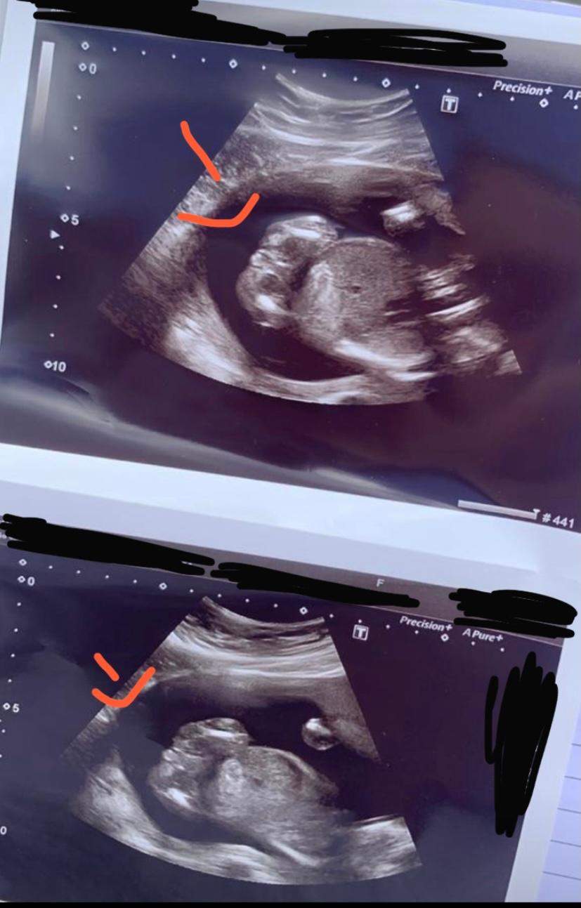 31 Ssw Und Frauenarzt Kann Mir Immernoch Nicht Geschlecht Sagen Schwangerschaft 31 Ssw Und Frauenarzt Kann Mir Immernoch Nicht Geschlecht Sagen Schwangerschaft