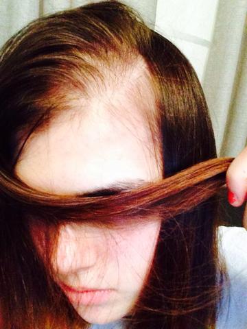 Haarausfall Ich Bin Am Ende Medikamente Haarausfall Ich Bin Am Ende Medikamente