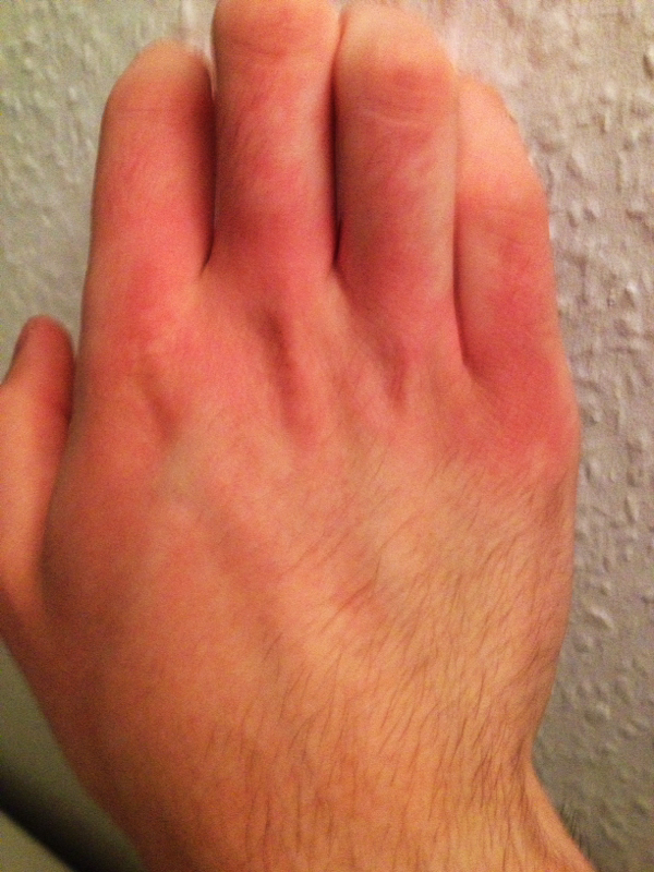 Handknochen gerötet/brennen? (Medizin, Hautarzt, Rötung)