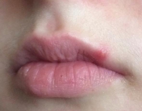 Meine Lippe aktuell :/ - (Gesundheit, Beauty, Pickel)