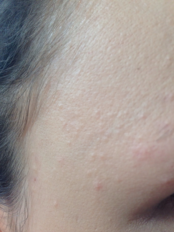 Kleine Pickelchen Im Gesicht Hilfe Haut Pickel Hautpflege