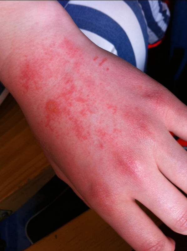 Edding auf der Hand (hatte)