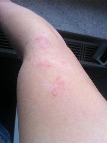 Rote flecken an meinem arm - (Allergie, Ausschlag, rote flecken)