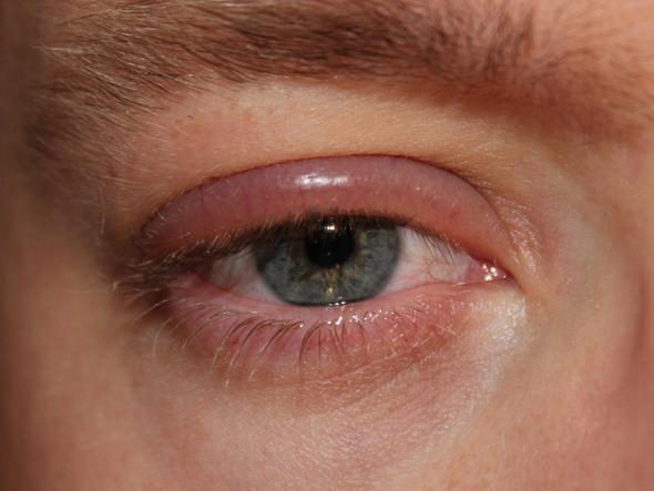 mein Auge sieht ca. So aus wie auf dem Bild:) das ist nicht mein Auge:) - (Gesundheit und Medizin, rot, geschwollen)