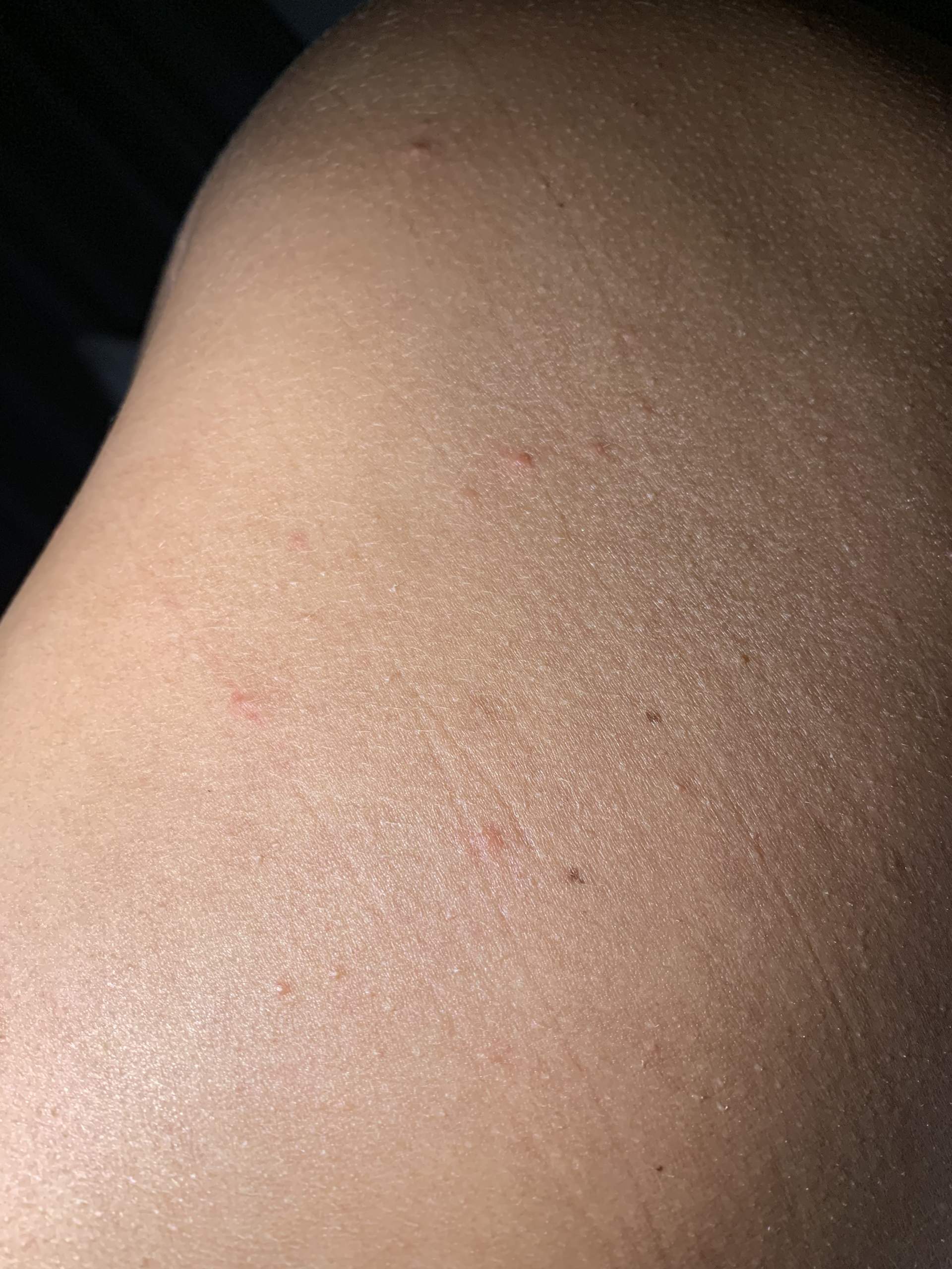 Kleine Stiche Am Krper