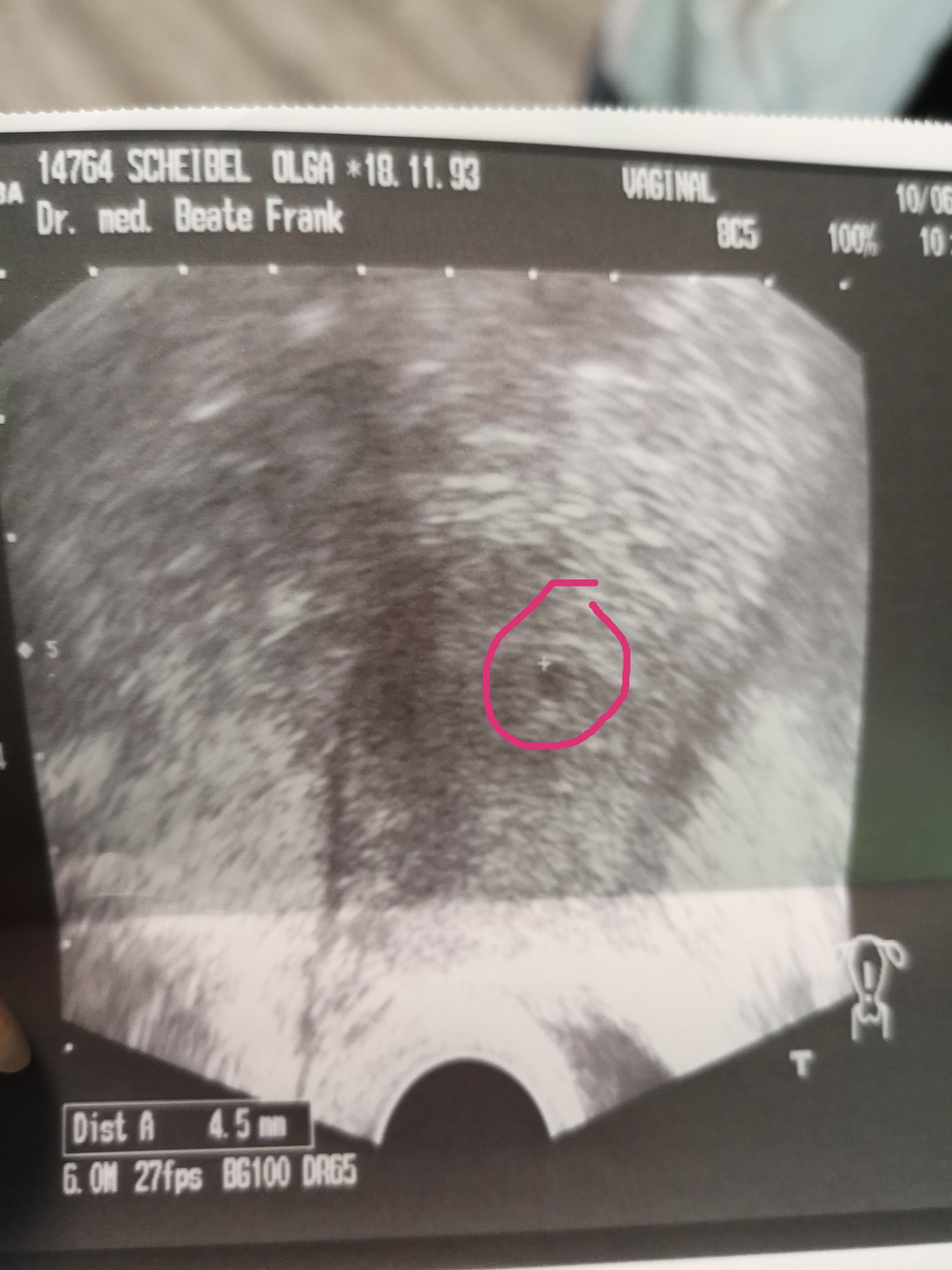 5 1 Ssw Schwangerschaft 5 1 Ssw Schwangerschaft