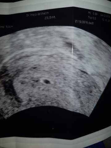 5 2 Ssw Schwangerschaft Ultraschall