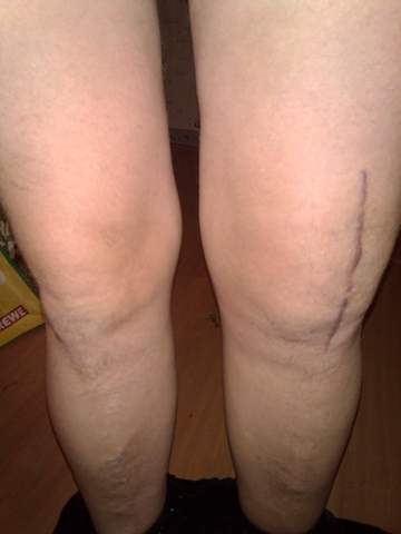 7 Monate Nach Knie Op Noch Immer Schmerzen Und Dickes Knie Gesundheit Und Medizin Schmerzen Im Knie Knie Operation 7 Monate Nach Knie Op Noch Immer Schmerzen Und Dickes Knie Gesundheit Und Medizin Schmerzen Im Knie Knie Operation