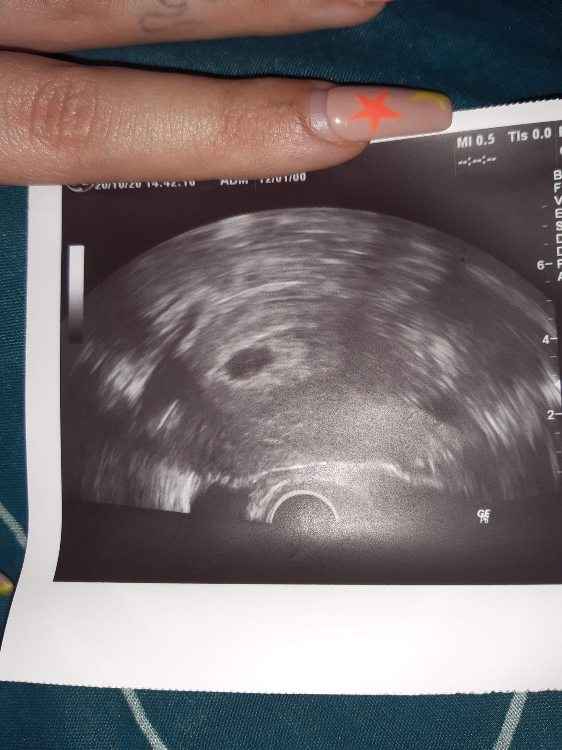 7 1 Ssw Arztin Meint 5 Ssw Gesundheit Und Medizin Schwangerschaft Fruhschwangerschaft 7 1 Ssw Arztin Meint 5 Ssw Gesundheit Und Medizin Schwangerschaft Fruhschwangerschaft