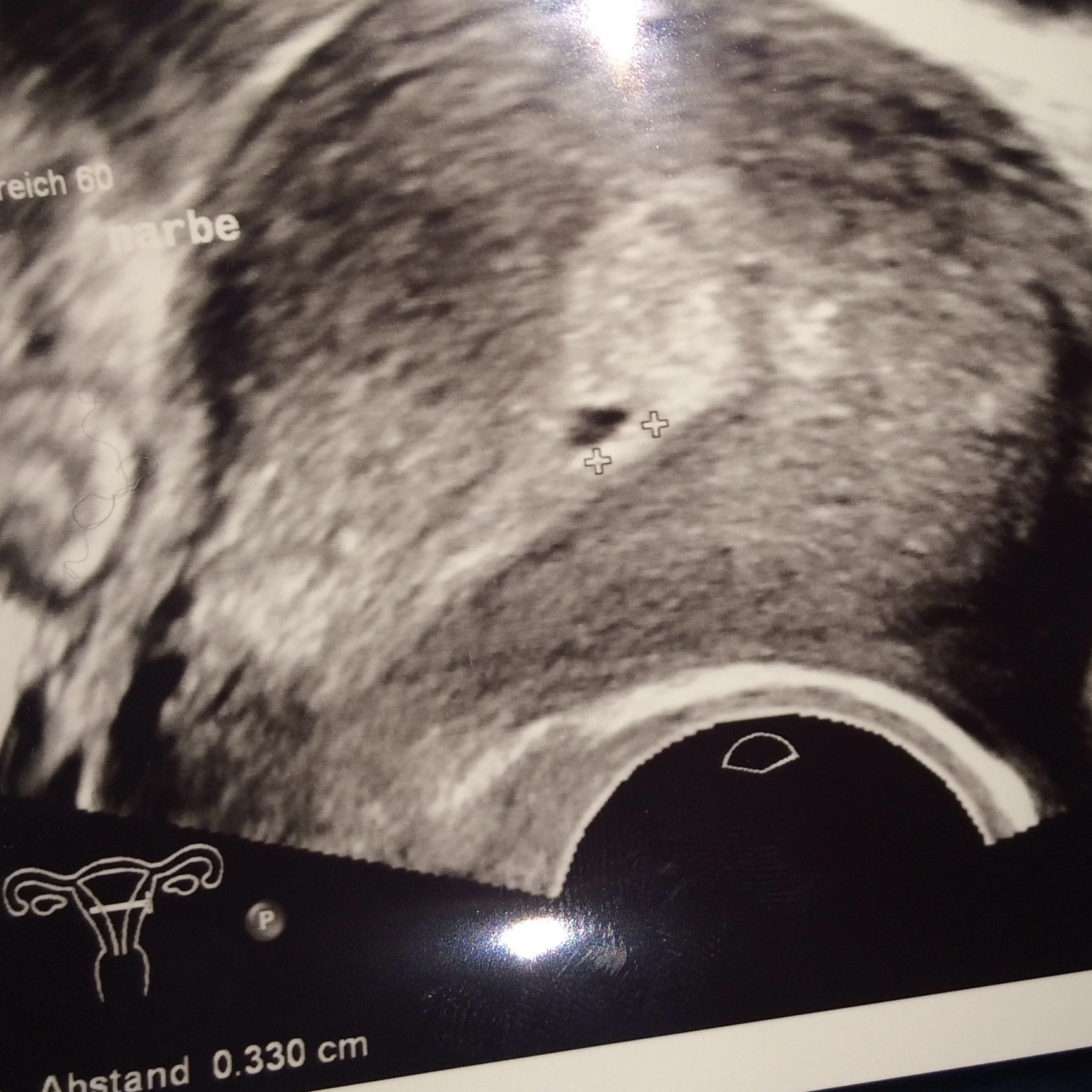 7ssw nur fruchthöhle zu sehen, gibt es noch Hoffnung? (Schwangerschaft 7ssw nur fruchthöhle zu sehen, gibt es noch Hoffnung? (Schwangerschaft