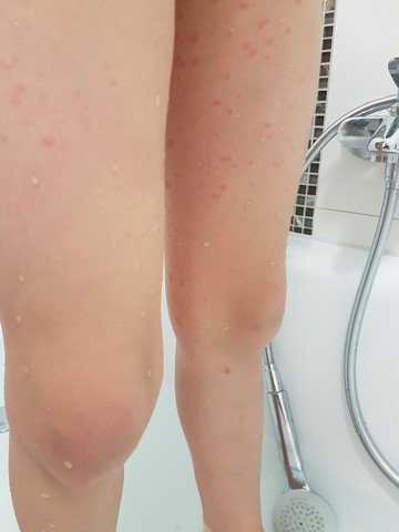 8 Jahriger Hat Hautausschlag Was Kann Das Sein Ausschlag Kinderkrankheiten 8 Jahriger Hat Hautausschlag Was Kann Das Sein Ausschlag Kinderkrankheiten