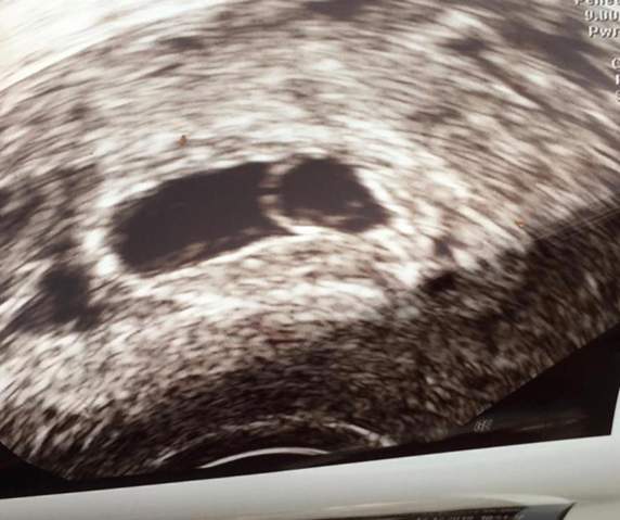 8 Ssw Dottersack Kein Embryo Zu Sehen Kinder Schwangerschaft Frauenarzt