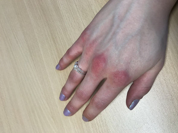 Ab Handrucken Rote Finger Und Knochel Weiss Jemand Was Es Sein Konnte Gesundheit Und Medizin Hand Ab Handrucken Rote Finger Und Knochel Weiss Jemand Was Es Sein Konnte Gesundheit Und Medizin Hand