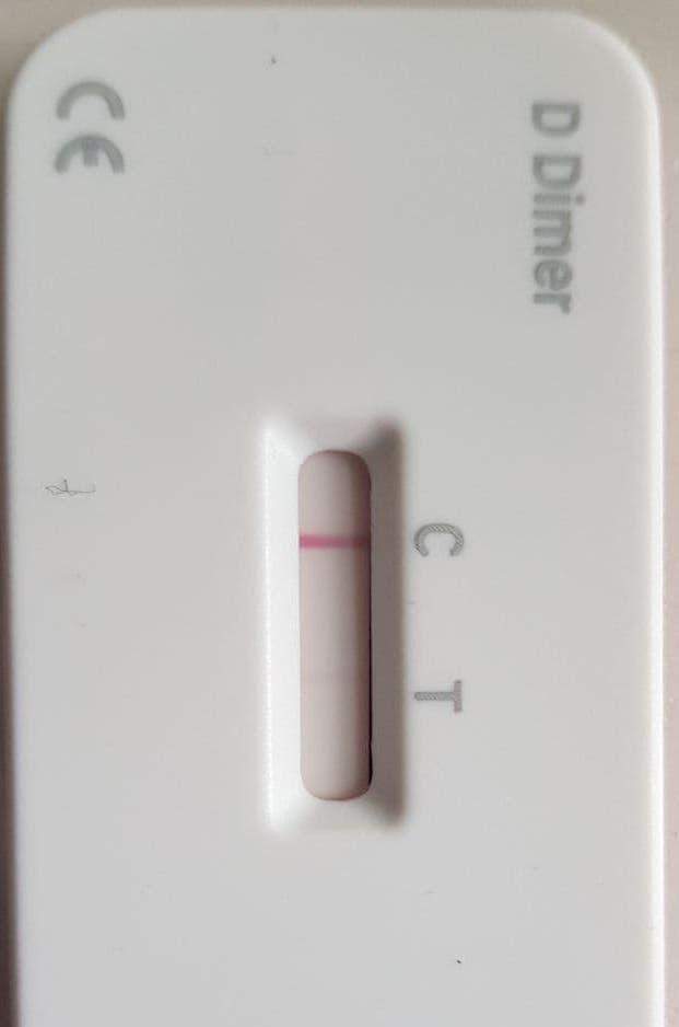Ab wann ist mein D-Dimere Test positiv/ liegt eine Thrombose vor