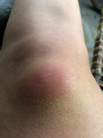 Ab wann muss ich mit einem Mückenstich zum Arzt? (Gesundheit, mueckenstich)