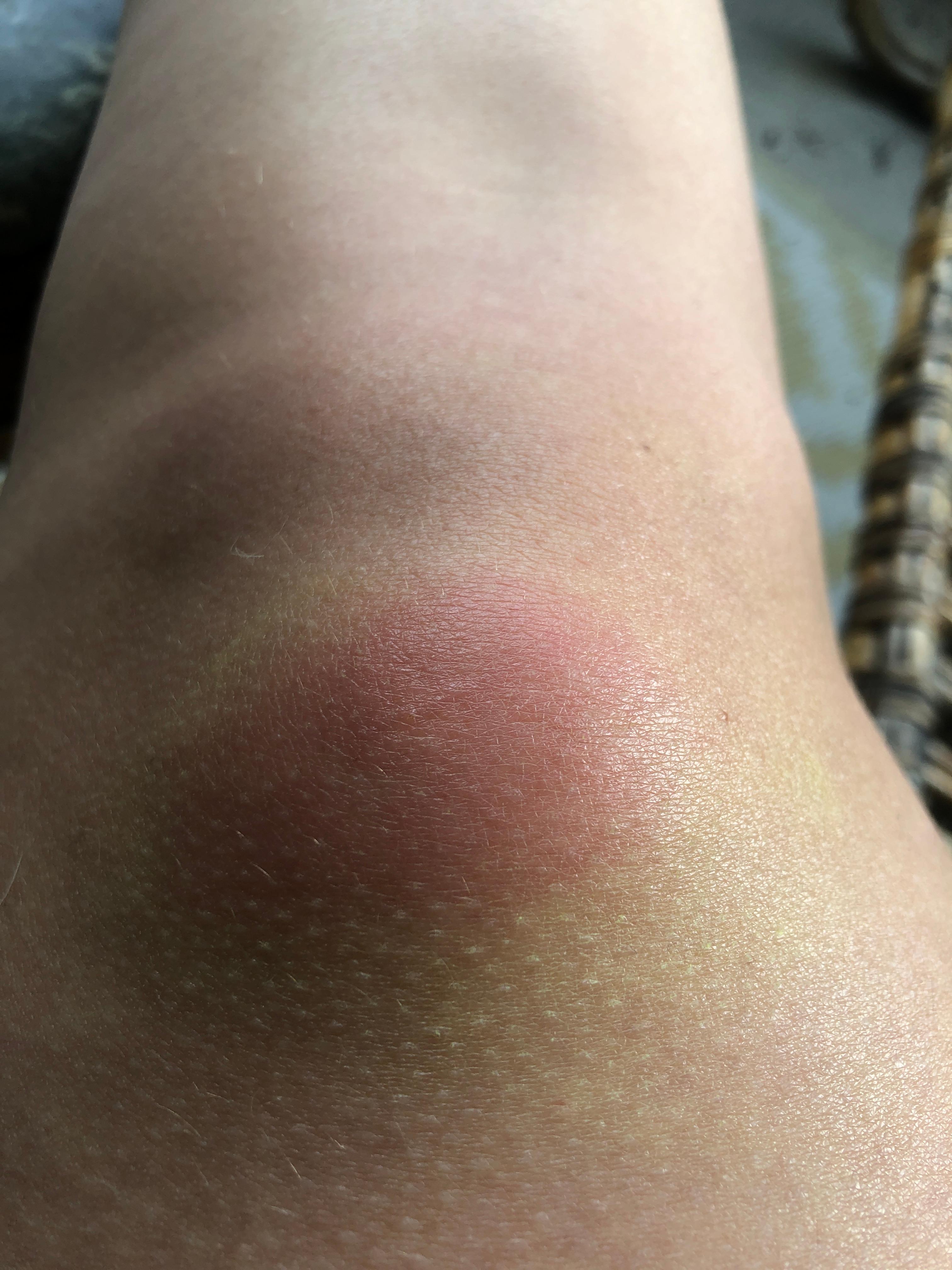 Ab Wann Muss Ich Mit Einem Muckenstich Zum Arzt Gesundheit Mueckenstich Ab Wann Muss Ich Mit Einem Muckenstich Zum Arzt Gesundheit Mueckenstich