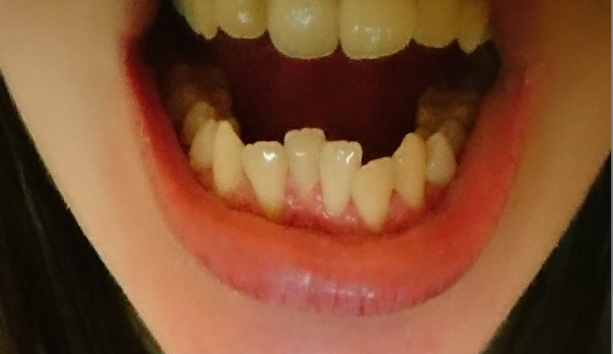 Vorstehende zähne