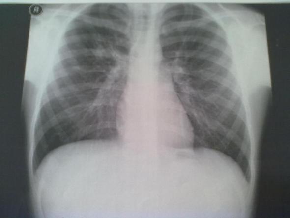 - (Krankheit, Kinder, Tuberkulose)