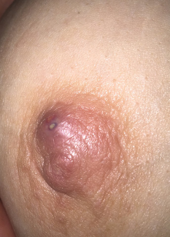 Meine brustwarze mit abszess - (Abszess, Sepsis)