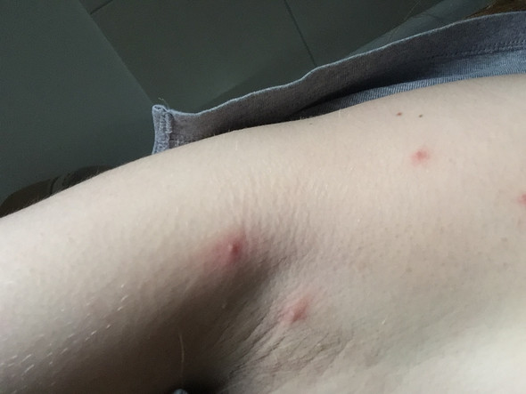 Abszess Oder Pickel In Der Achsel Gesundheit Schmerzen Haut Abszess Oder Pickel In Der Achsel Gesundheit Schmerzen Haut