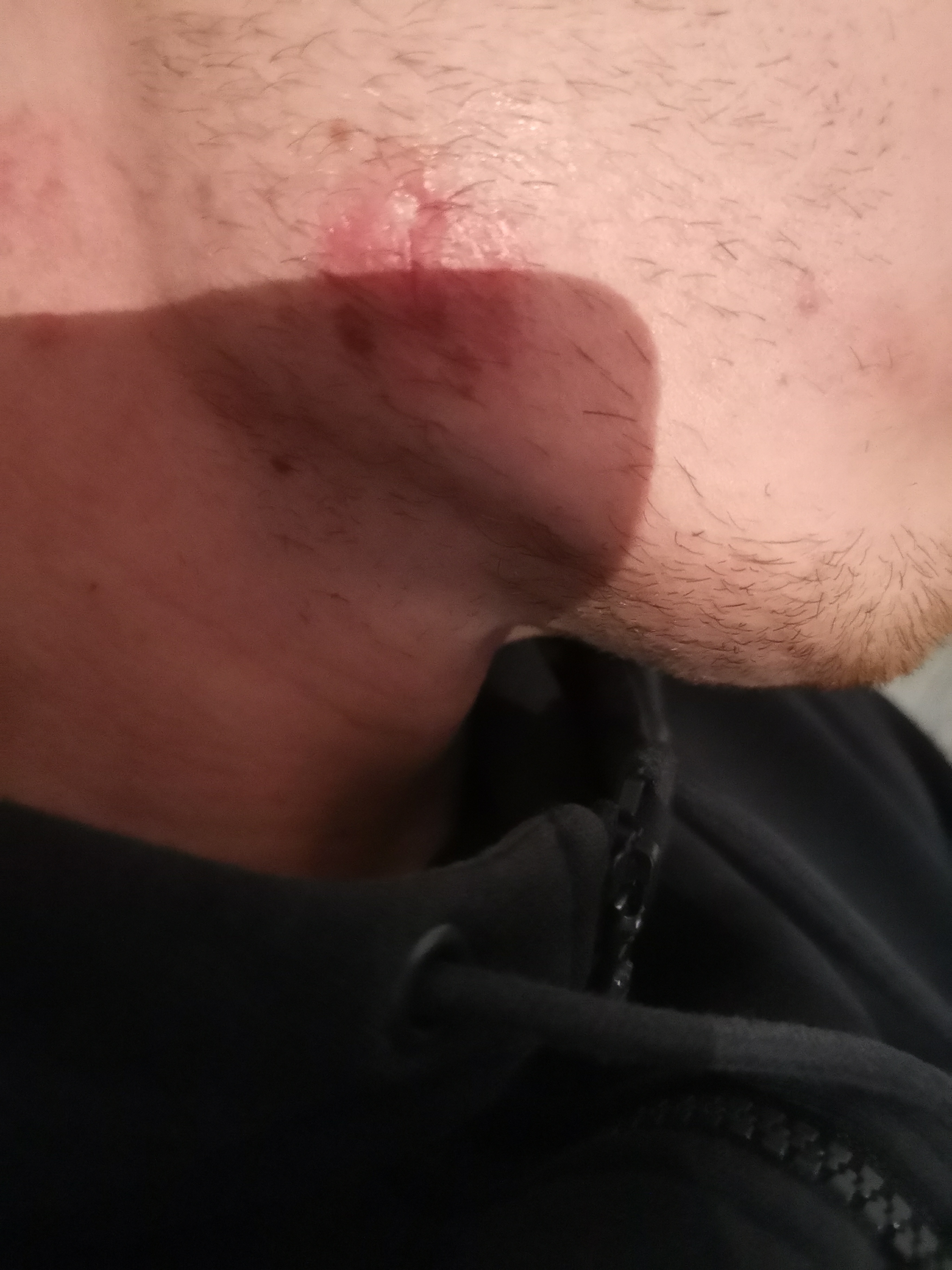 abzess furunkel eingewachsenes haar