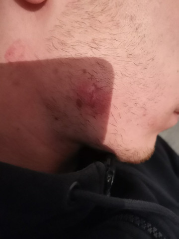 abzess furunkel eingewachsenes haar