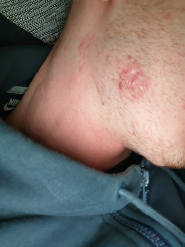 abzess furunkel eingewachsenes haar