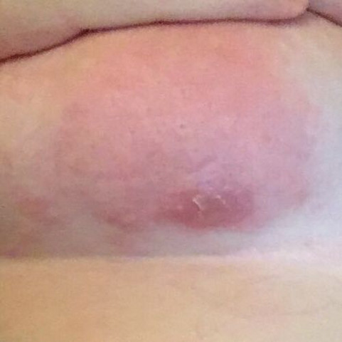 Abzess Oder Doch Was Anderes Gesundheit Und Medizin Haut Entzundung Abzess Oder Doch Was Anderes Gesundheit Und Medizin Haut Entzundung