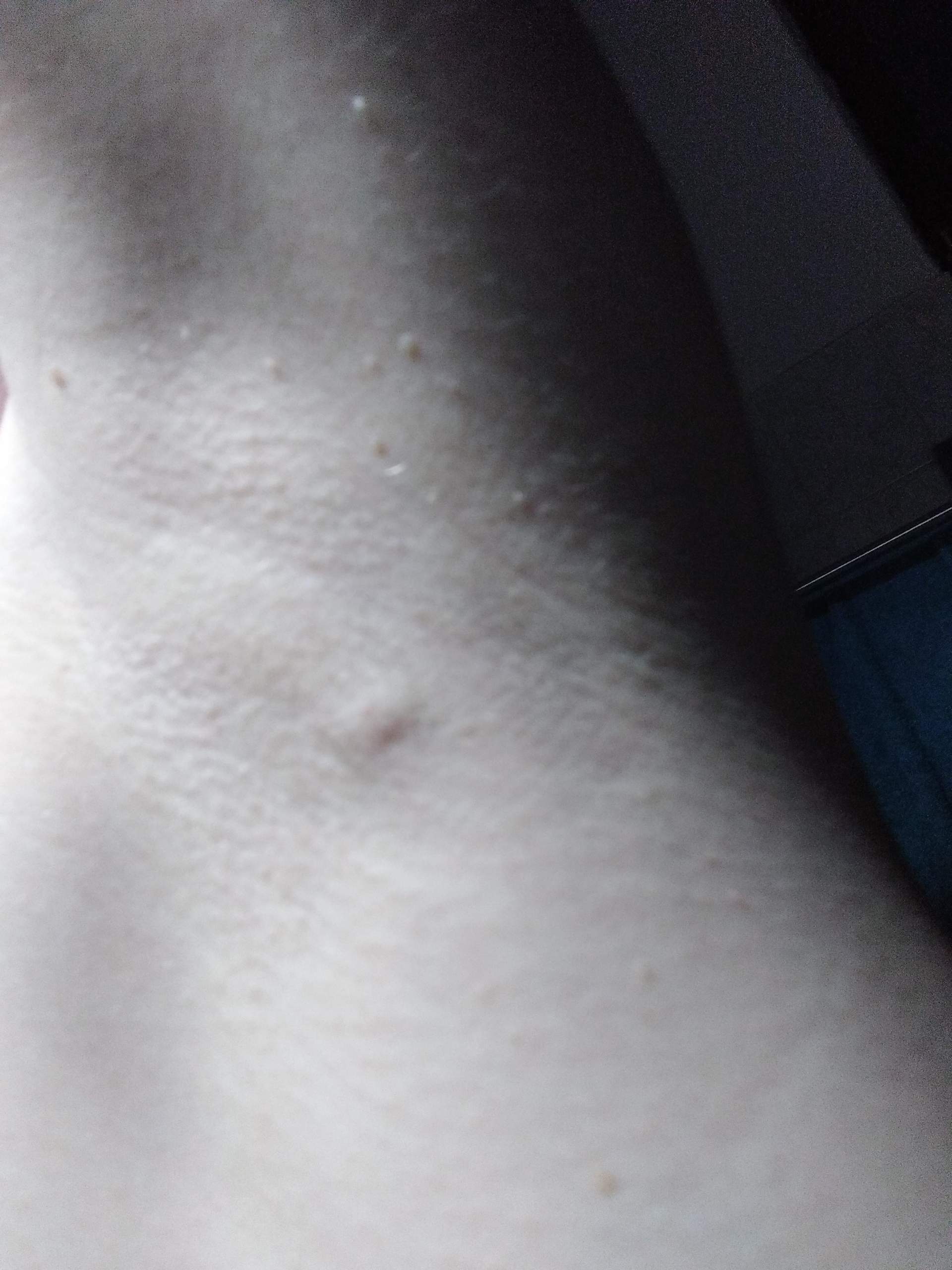 Abzess unter der Haut aufgegangen? (Gesundheit und Medizin, Gesundheit ...