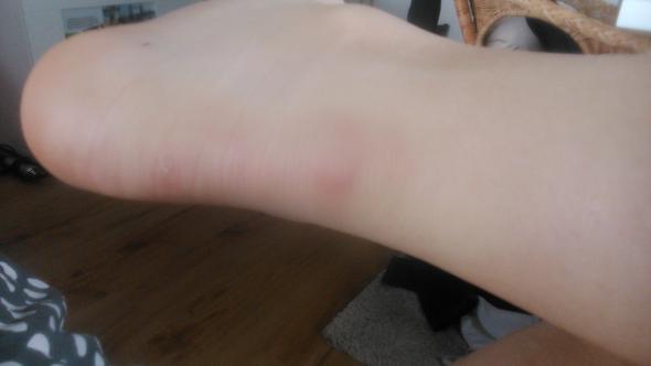 Achillessehne Riss Anriss Entzundung Gesundheit Korper Arzt