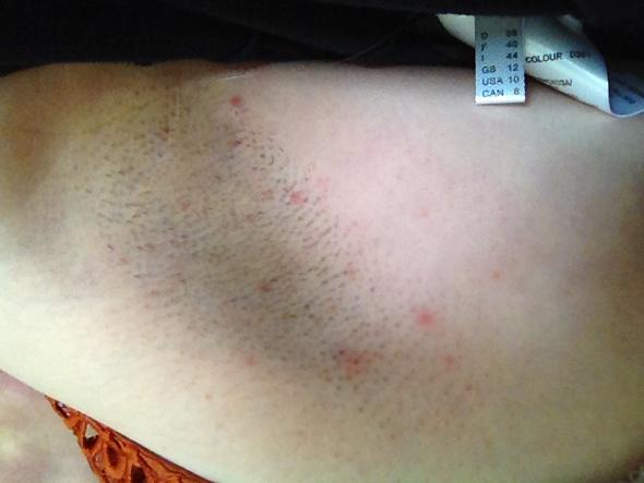 intimrasur ohne pickel