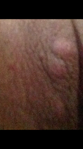 Haut schamlippe unter protcachimom: Herpes