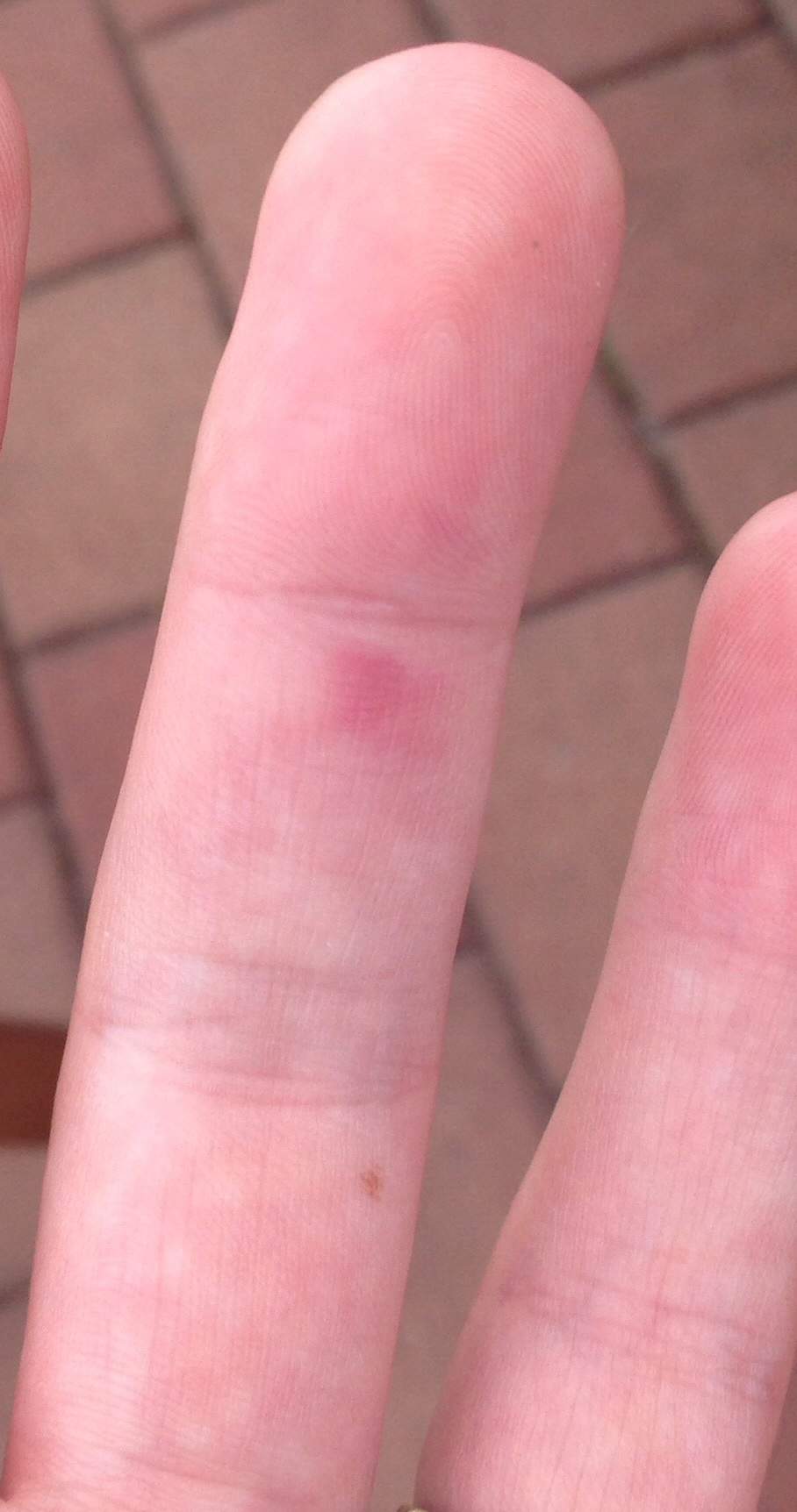 Ader am Finger geplatzt. 28. SSW. Schlimm oder harmlos? (Gesundheit