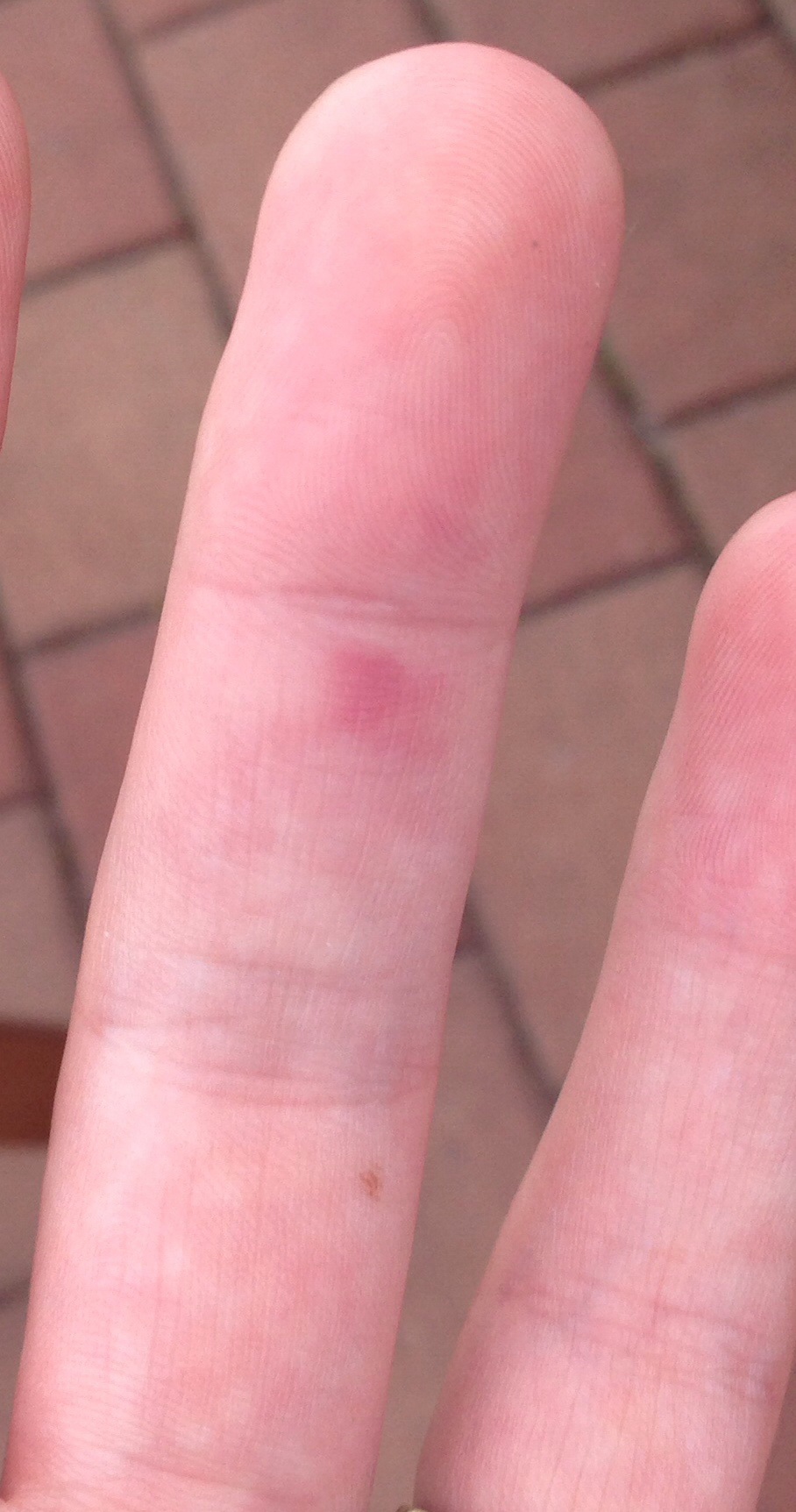 Ader am Finger geplatzt. 28. SSW. Schlimm oder harmlos? (Gesundheit, Schwangerschaft) Ader am Finger geplatzt. 28. SSW. Schlimm oder harmlos? (Gesundheit, Schwangerschaft)