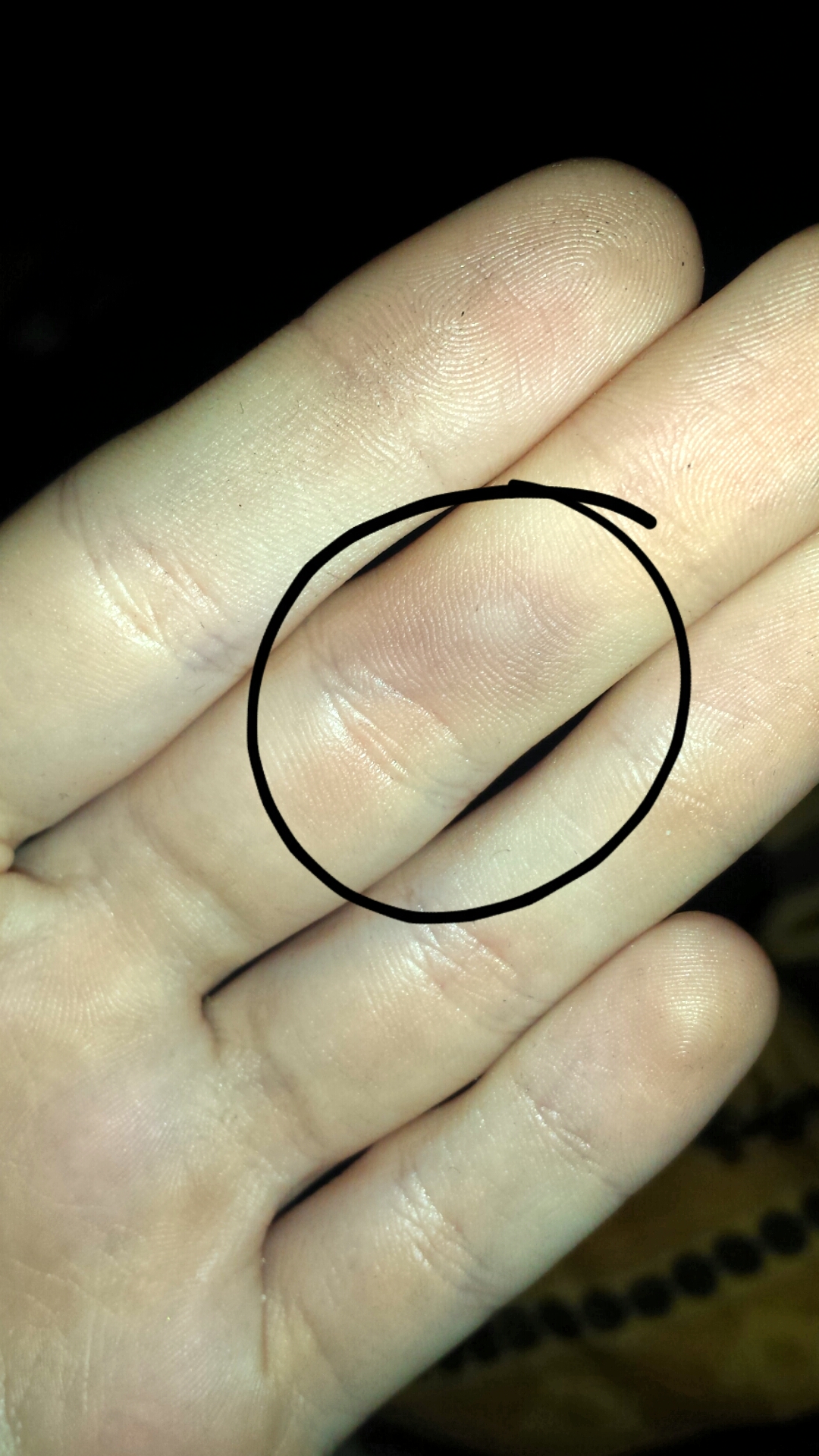 Ader am Finger wird blauer und dicker? (Medizin) Ader am Finger wird blauer und dicker? (Medizin)