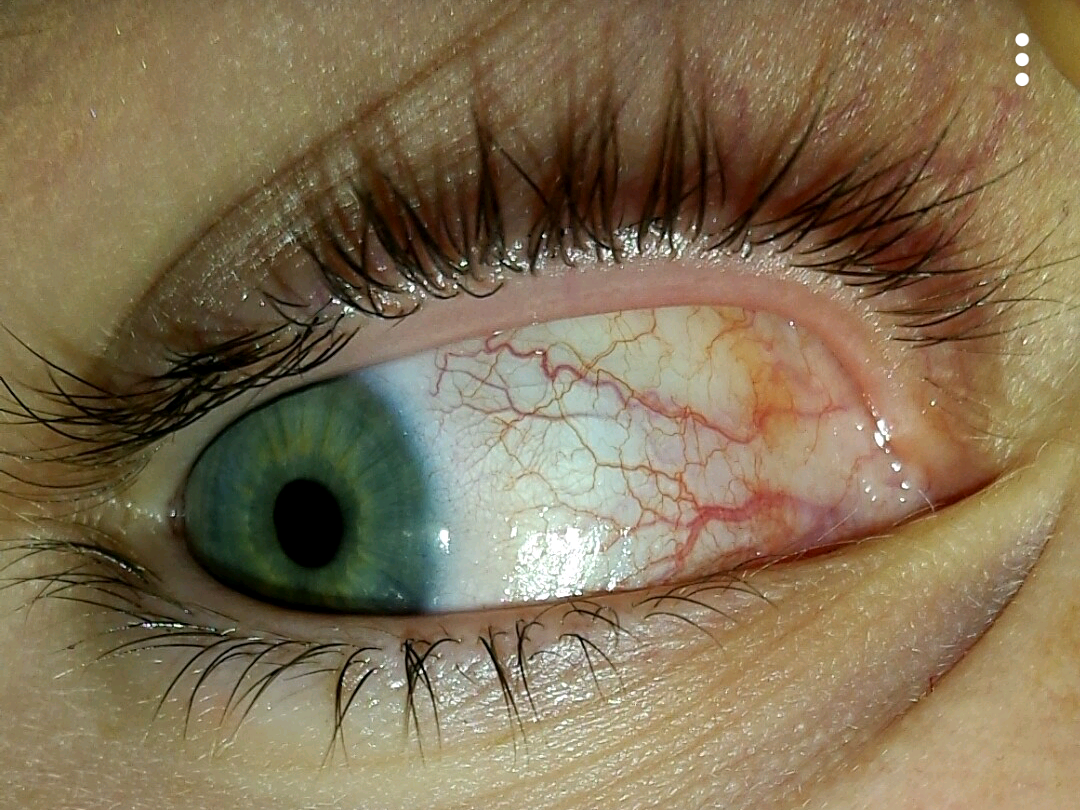 Ader im Auge geplatzt. Was ist das/+Bild? (Schmerzen, Augen)
