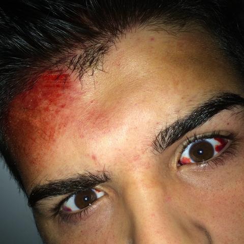 Geplatze Ader Im Auge - Captions Profile